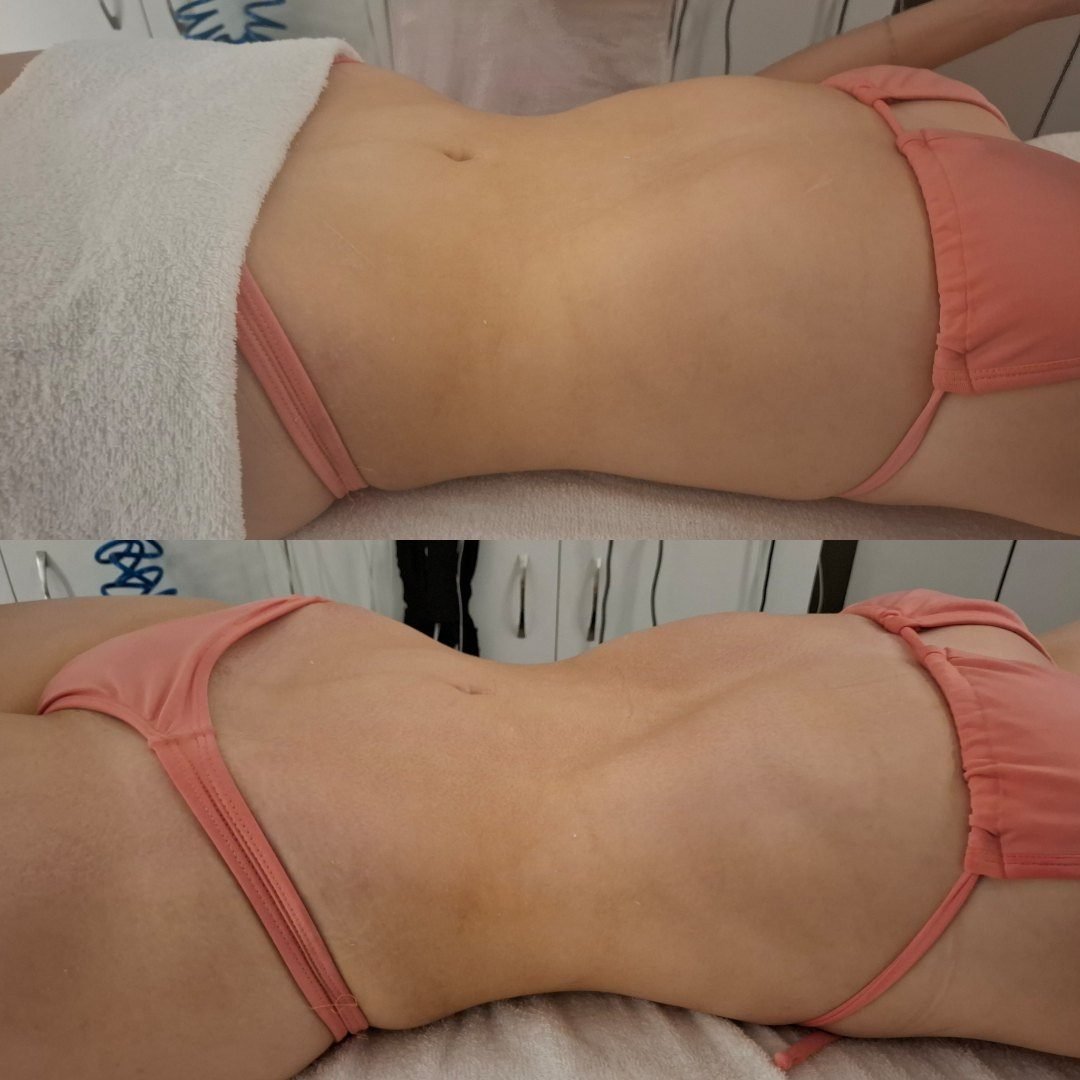 Drenagem linfática. Massagem modeladora — foto 2